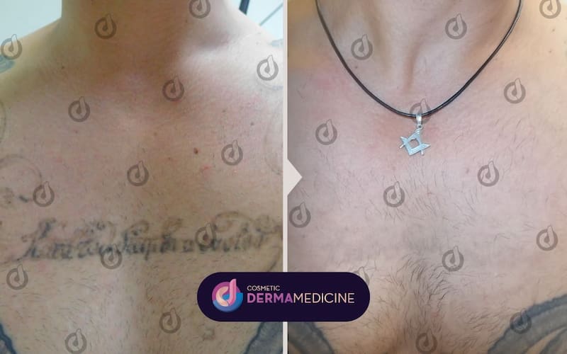 Αποτέλεσμα αφαίρεσης τατουάζ στο στήθος πριν και μετά.