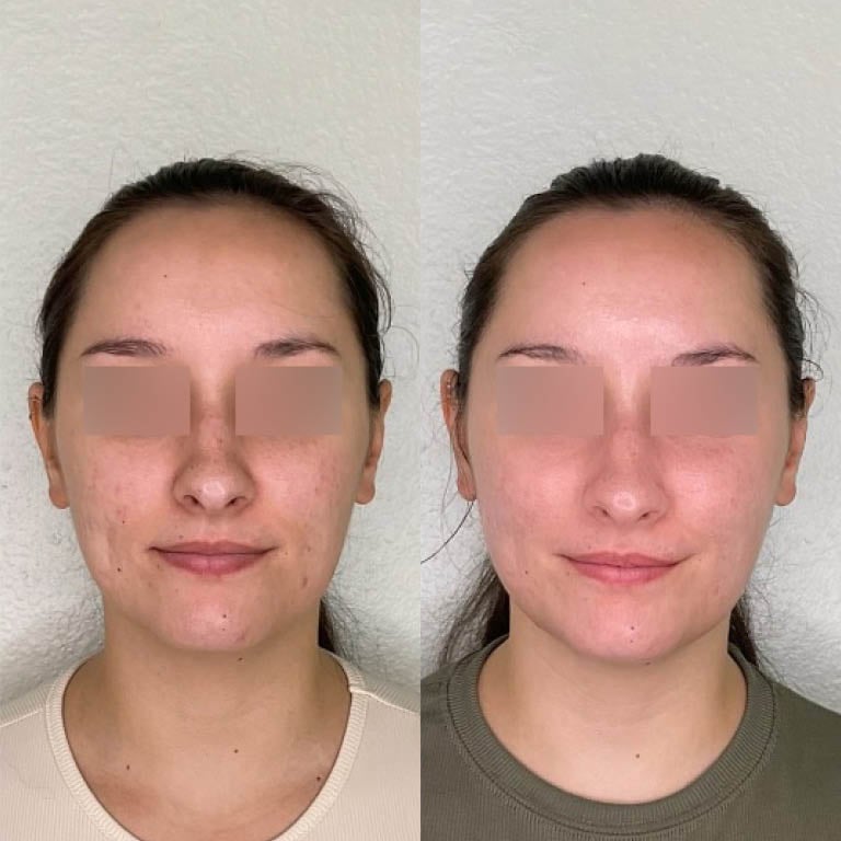 Result of treating fine lines and wrinkles after microneedling treatment.