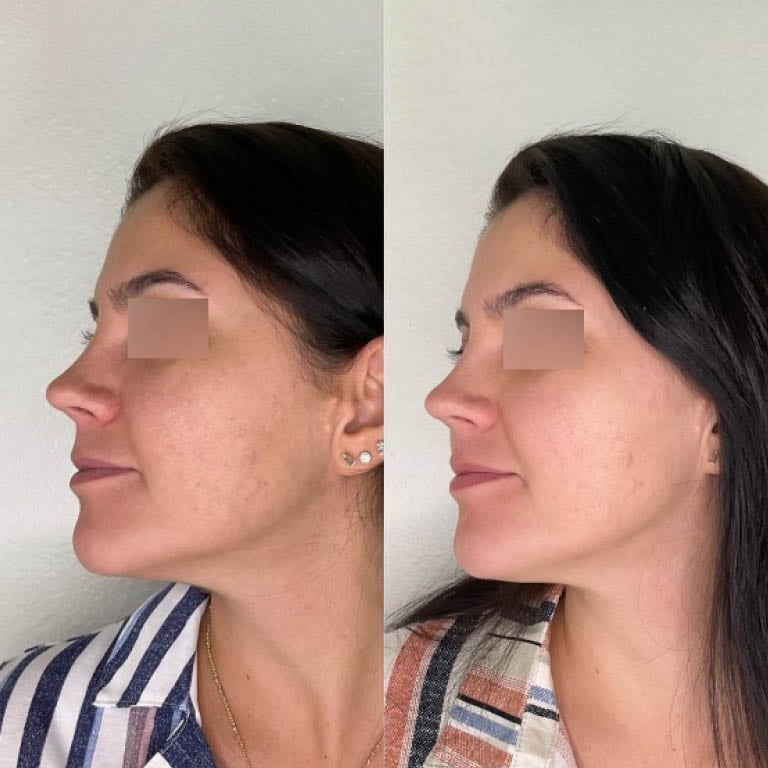 Elimination of dark circles and skin tightening after microneedling treatment.