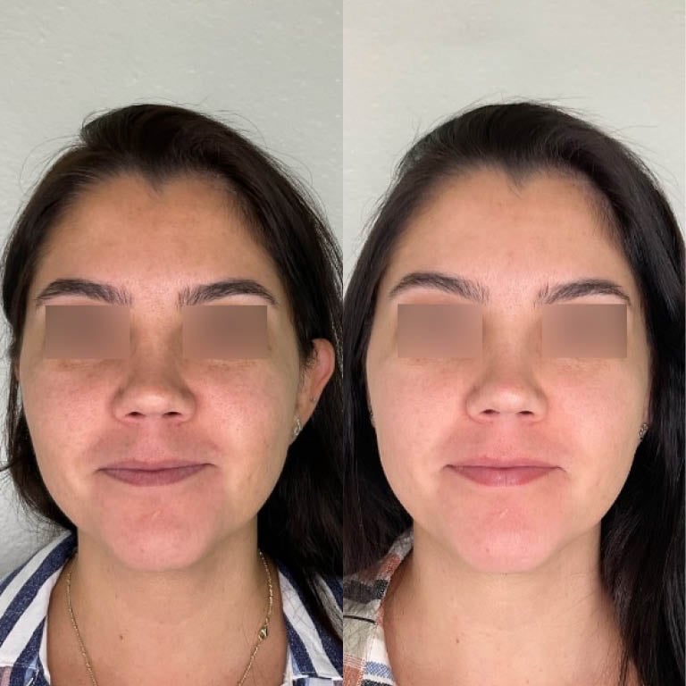 Facial rejuvenation, tightening, and smoothing of the skin with microneedling.
