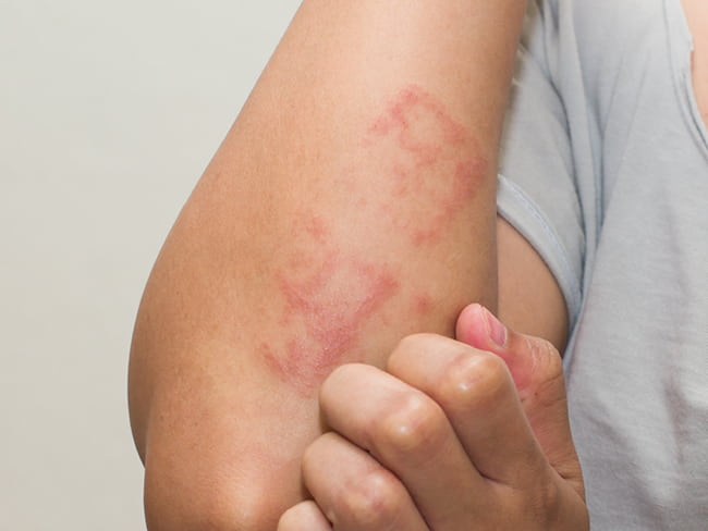 Eczema - Dermatitis