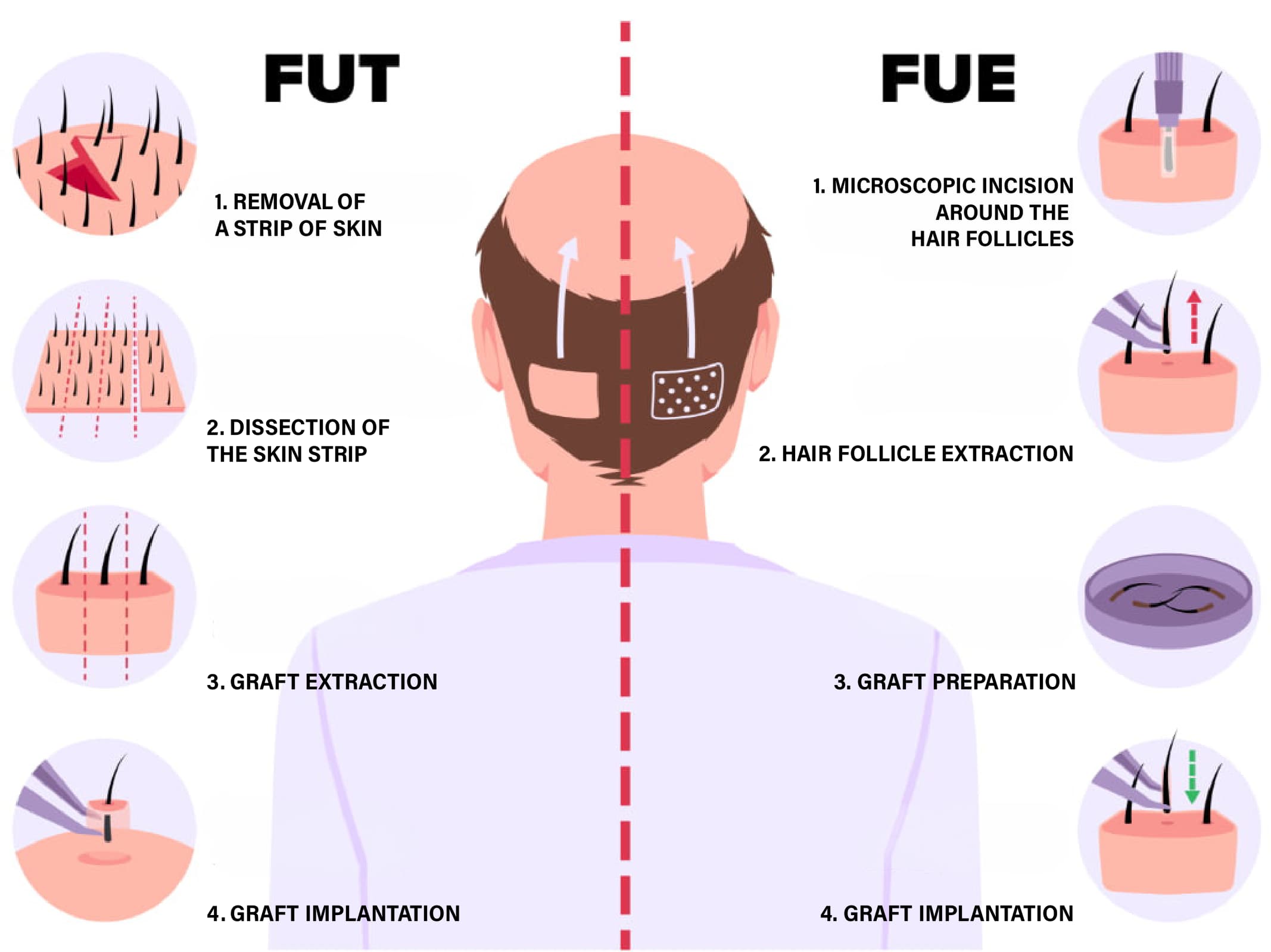 How is a hair transplant performed?