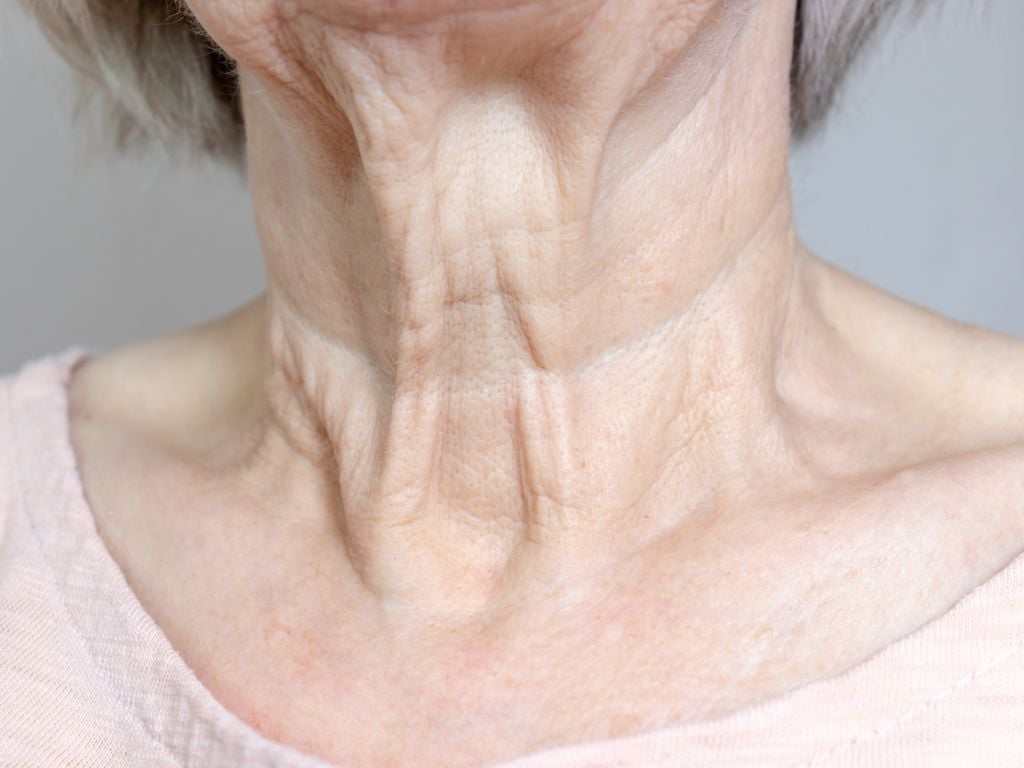 Mature neck with skin laxity, wrinkles and visible platysmal bands