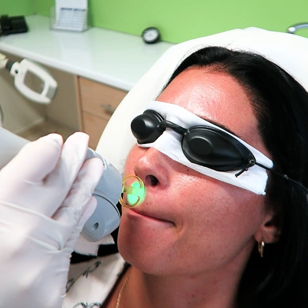Laser Αποτρίχωση Μικρή Περιοχή 20€ (Γυναίκες & Άνδρες)