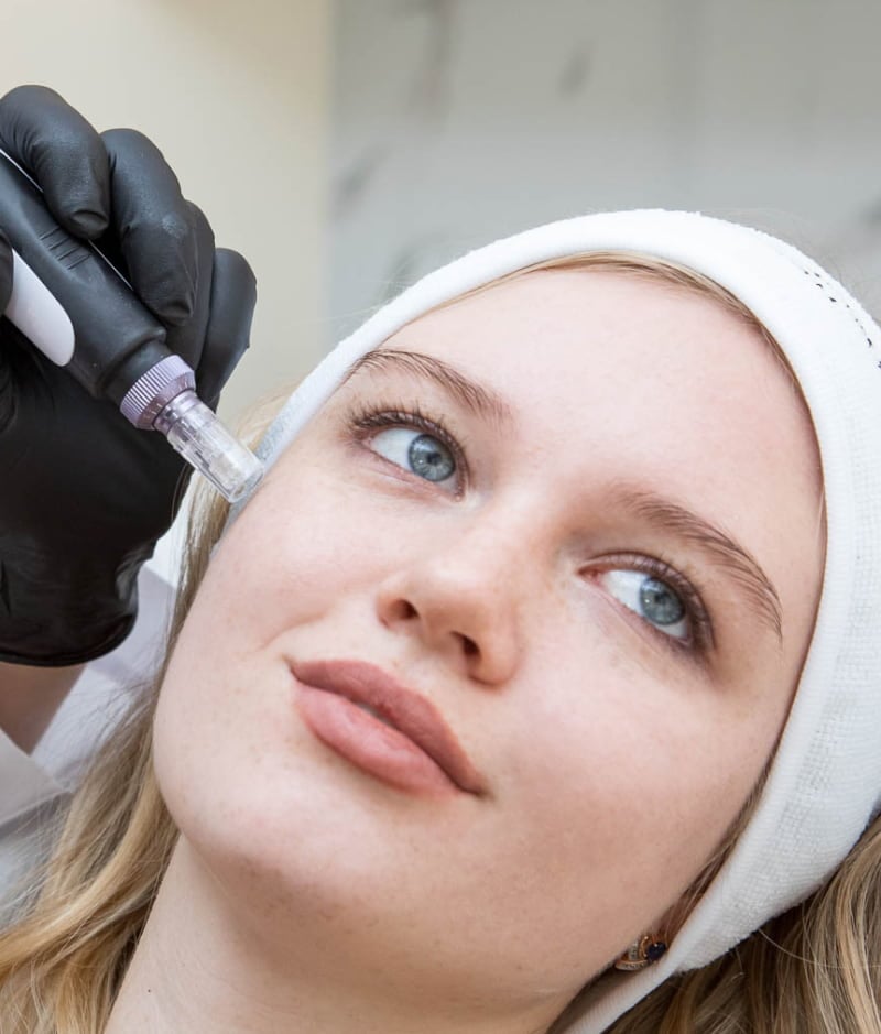 Acne treatment with mesotherapy.