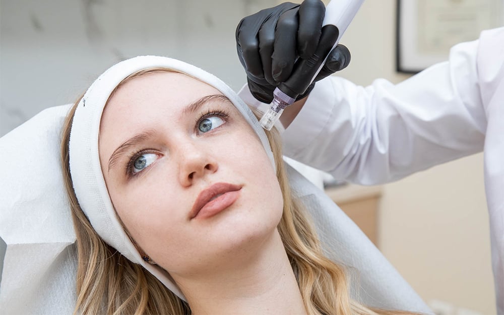 Microneedling για ακμή.