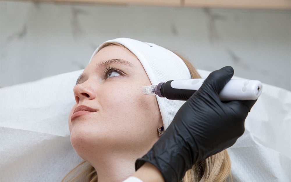 Acne scar treatment with microneedling.