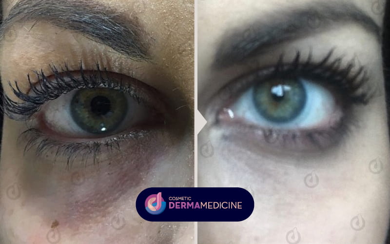 Αποτέλεσμα εφαρμογής υαλουρονικού οξέος στα μάτια πριν και μετά τη θεραπεία.