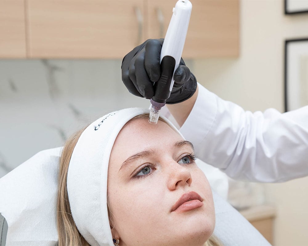 microneedling what is it.