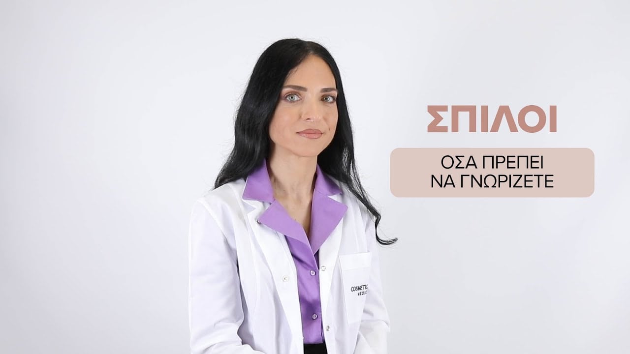Σπίλοι - Όλα όσα πρέπει να ξέρετε